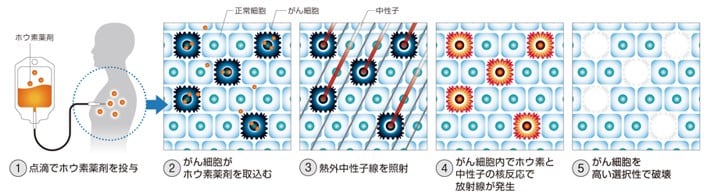 ホウ素中性子捕捉療法（BNCT）